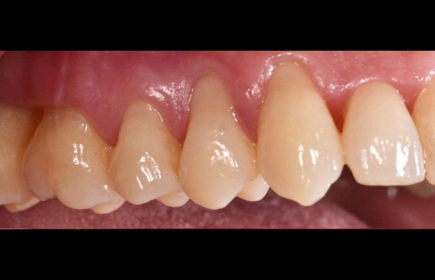 Greffe gingivale à partir d'un échantillon de gencive