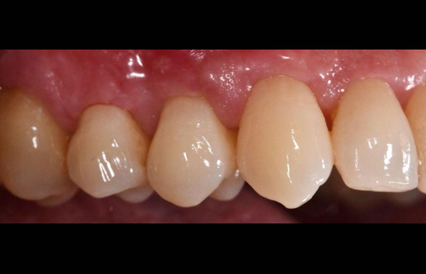 Greffe gingivale à partir d'un échantillon de gencive