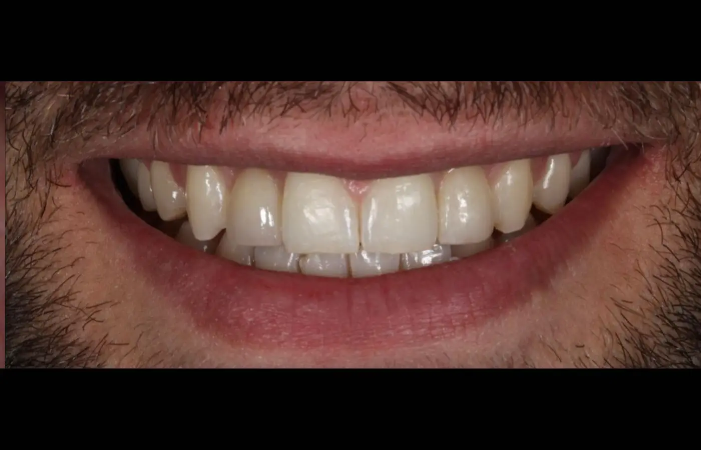 Pose de facette adaptée