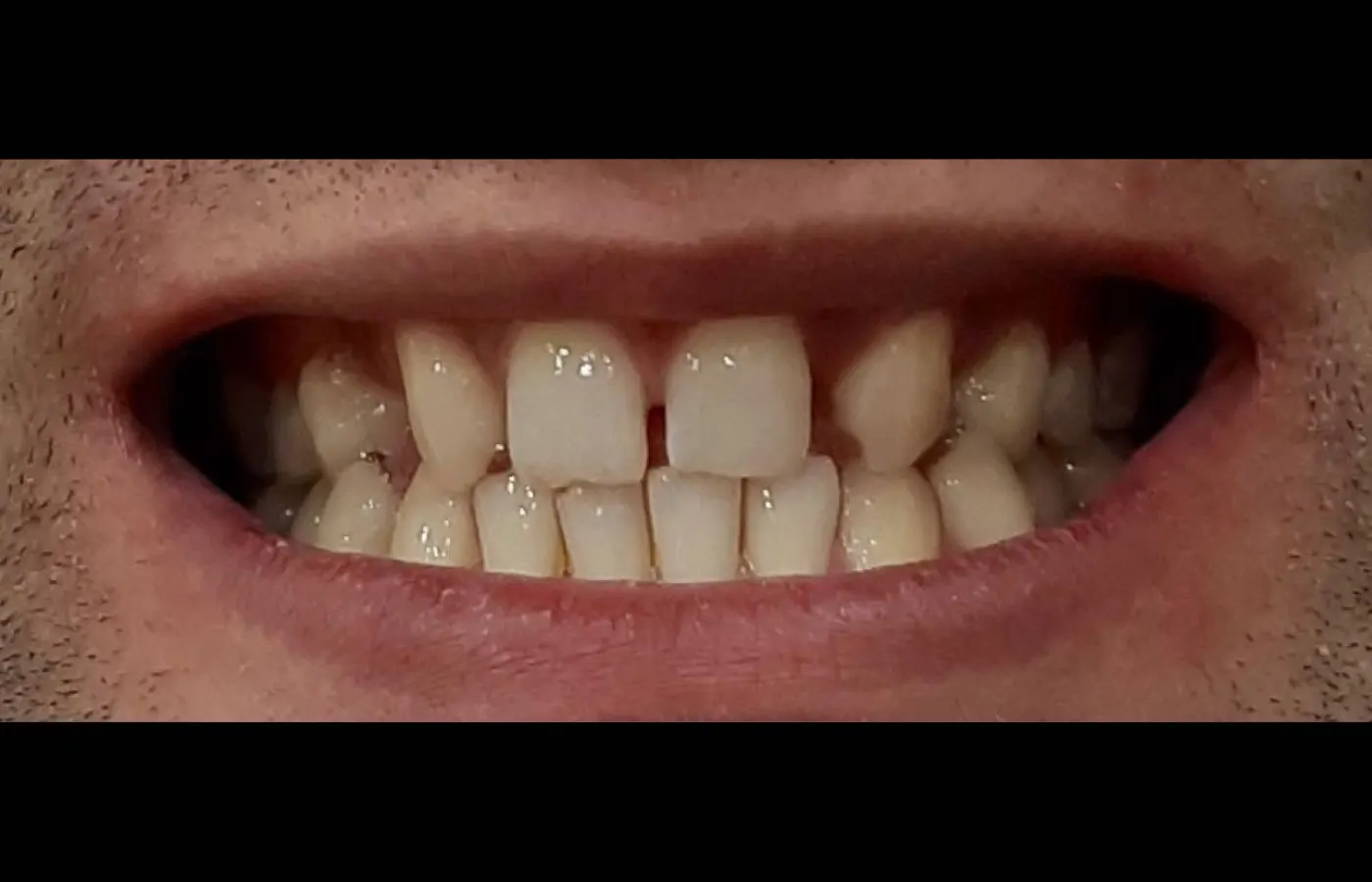 cas client avant pose de facette, avec un écart dentaire