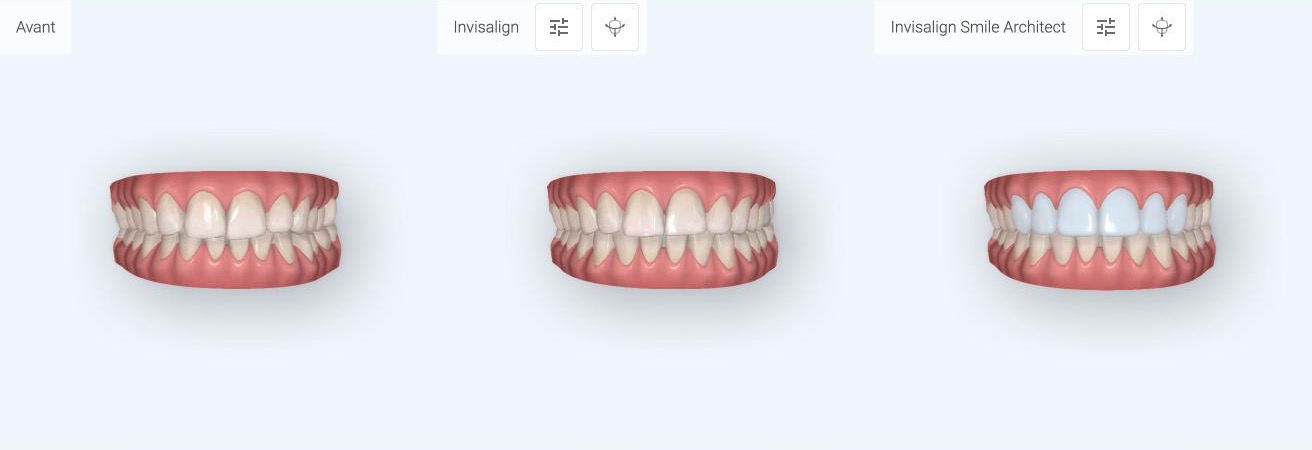 Outcome Simulator Pro : avant, après Invisalign, après Invisalign + Smile Architect.