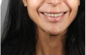 Photo du sourire de la patiente, yeux hors cadre : le point de départ de l'analyse.