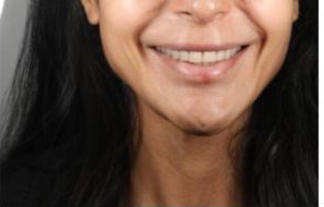 Simulation Invisalign