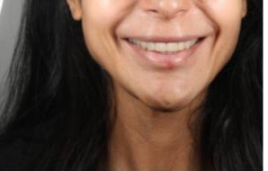 Simulation Smile Architect