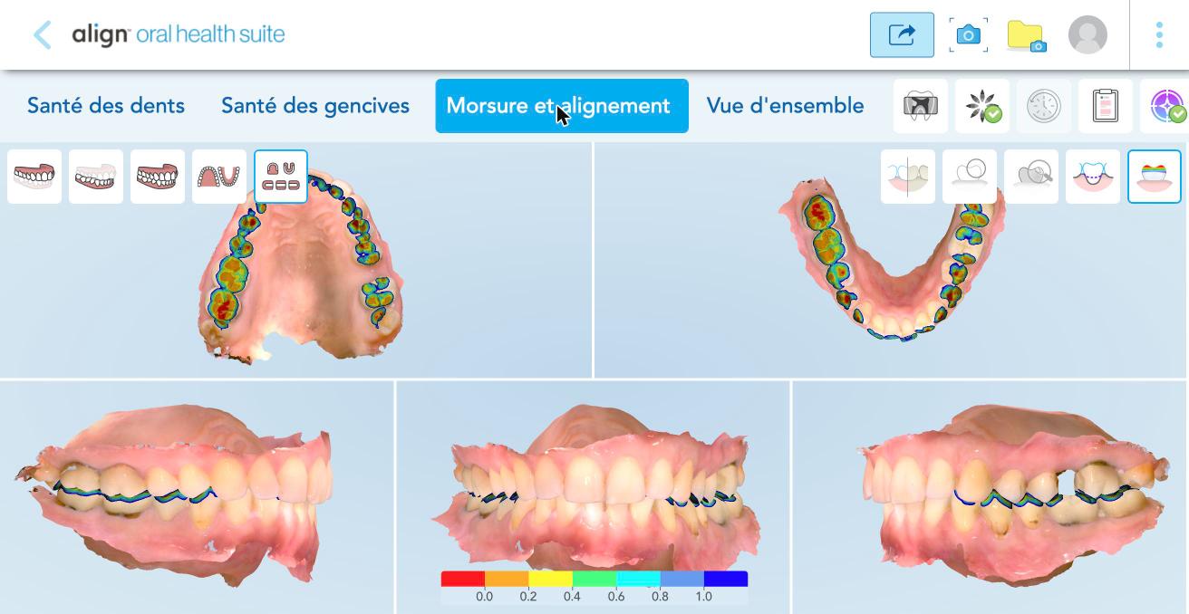 Morsure et alignement : les contacts entre les dents en couleurs.