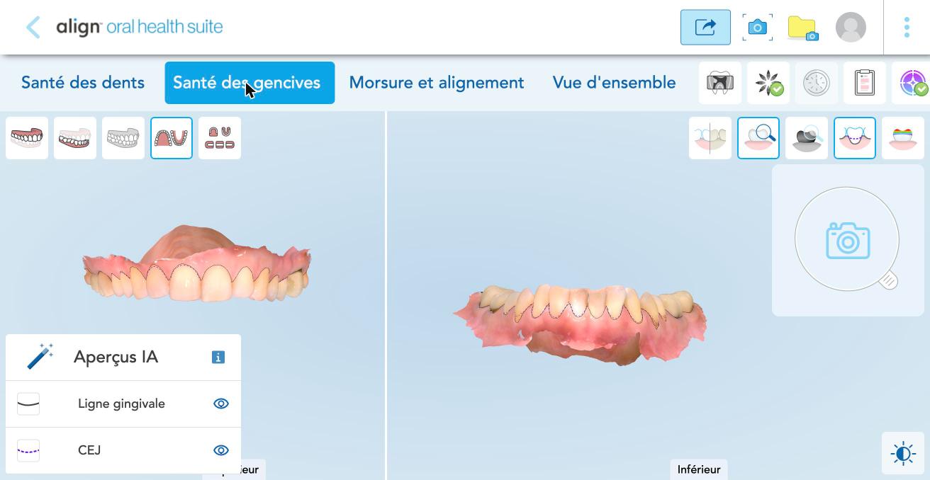 Santé des gencives : la ligne gingivale tracée automatiquement.